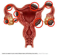 Webinar - Endometriosis